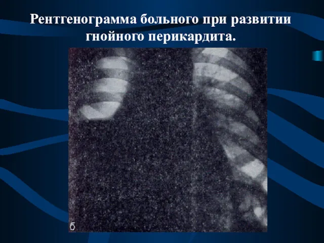 Рентгенограмма больного при развитии гнойного перикардита.