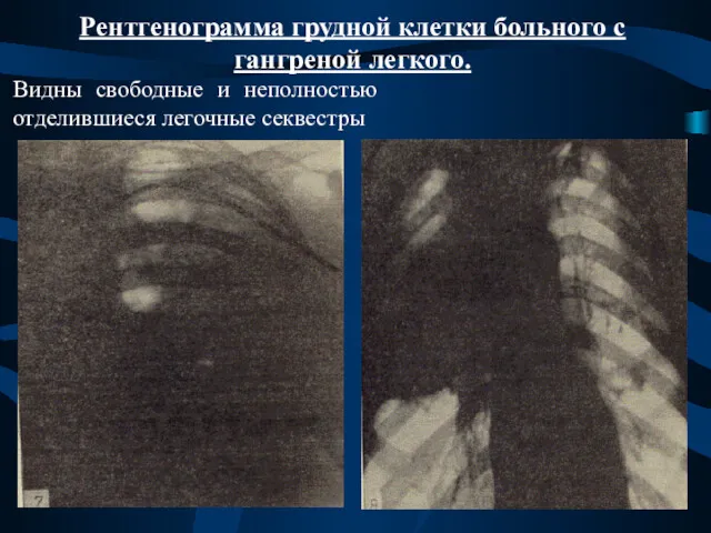Рентгенограмма грудной клетки больного с гангреной легкого. Видны свободные и неполностью отделившиеся легочные секвестры