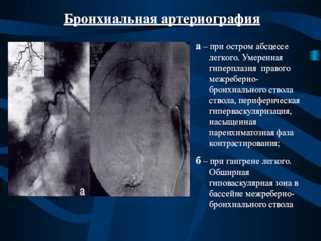 Бронхиальная артериография а – при остром абсцессе легкого. Умеренная гиперплазия правого межреберно-бронхиального ствола