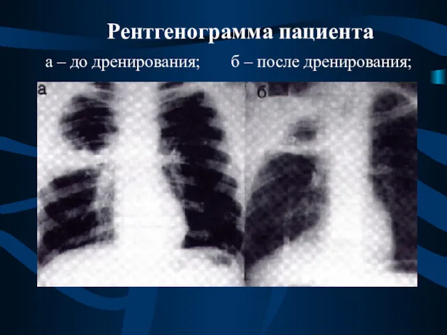 Рентгенограмма пациента а – до дренирования; б – после дренирования;