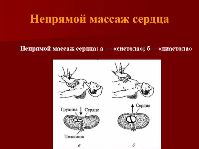 Непрямой массаж сердца Непрямой массаж сердца: а — «систола»; б— «диастола»