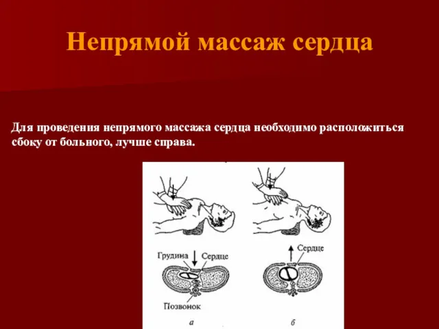 Непрямой массаж сердца Для проведения непрямого массажа сердца необходимо расположиться сбоку от больного, лучше справа.