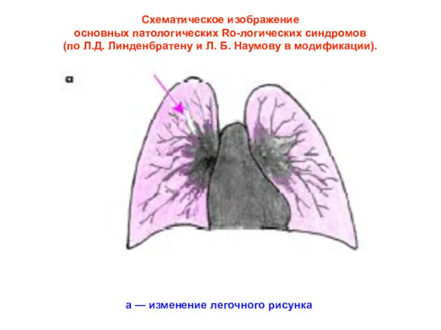 а — изменение легочного рисунка Схематическое изображение основных патологических Ro-логических