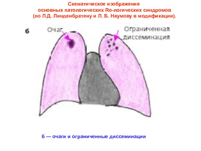 б — очаги и ограниченные диссеминации Схематическое изображение основных патологических