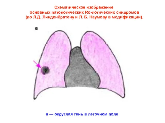 Схематическое изображение основных патологических Ro-логических синдромов (по Л.Д. Линденбратену и