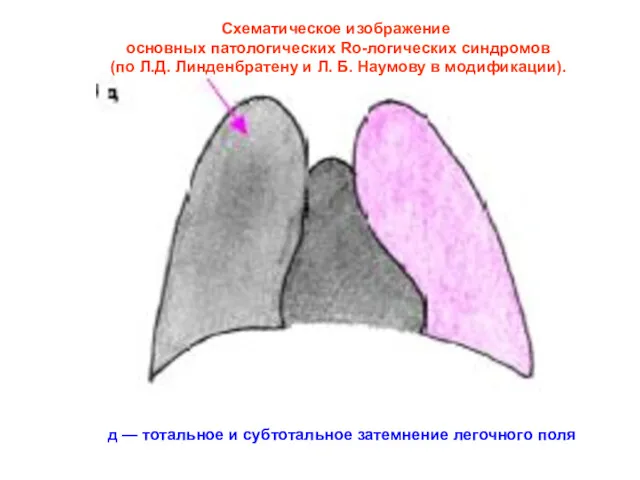 Схематическое изображение основных патологических Ro-логических синдромов (по Л.Д. Линденбратену и