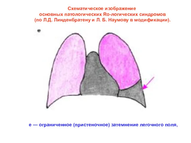 Схематическое изображение основных патологических Ro-логических синдромов (по Л.Д. Линденбратену и