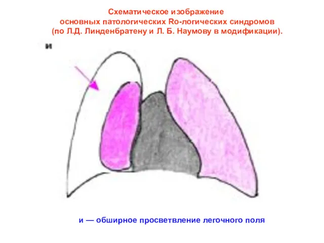 Схематическое изображение основных патологических Ro-логических синдромов (по Л.Д. Линденбратену и