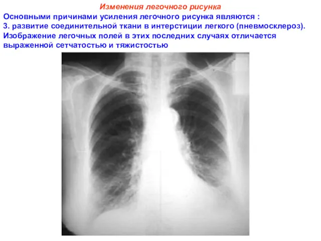 Изменения легочного рисунка Основными причинами усиления легочного рисунка являются :