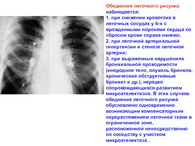 Обеднение легочного рисунка наблюдается: 1. при снижении кровотока в легочных