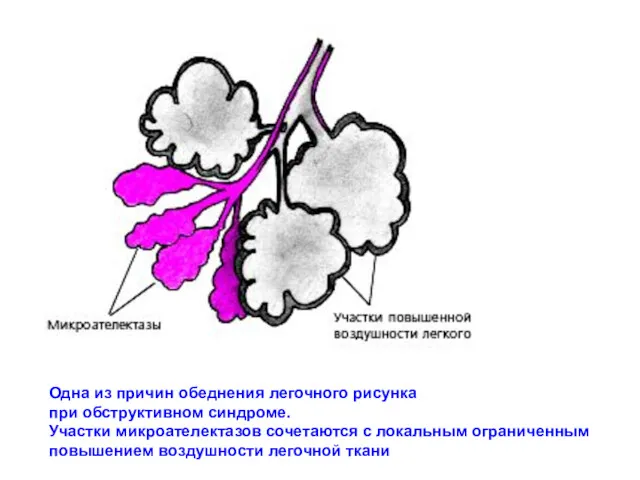 Одна из причин обеднения легочного рисунка при обструктивном синдроме. Участки