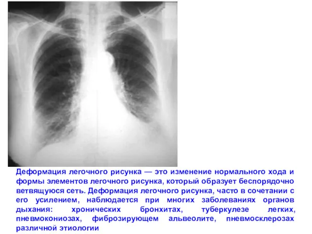 Деформация легочного рисунка — это изменение нормального хода и формы