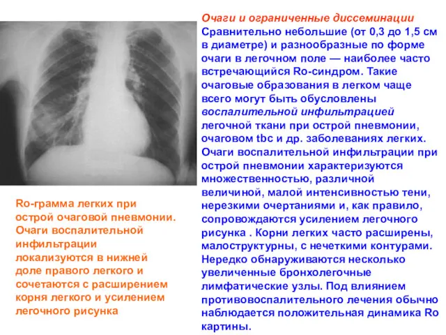 Очаги и ограниченные диссеминации Сравнительно небольшие (от 0,3 до 1,5