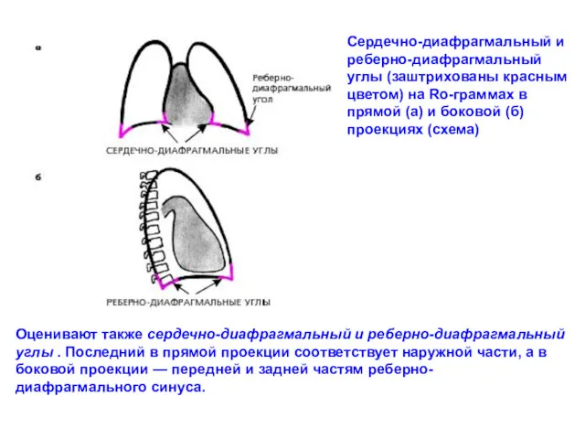 Сердечно-диафрагмальный и реберно-диафрагмальный углы (заштрихованы красным цветом) на Ro-граммах в