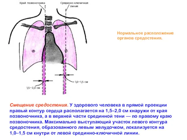 Нормальное расположение органов средостения. Смещение средостения. У здорового человека в