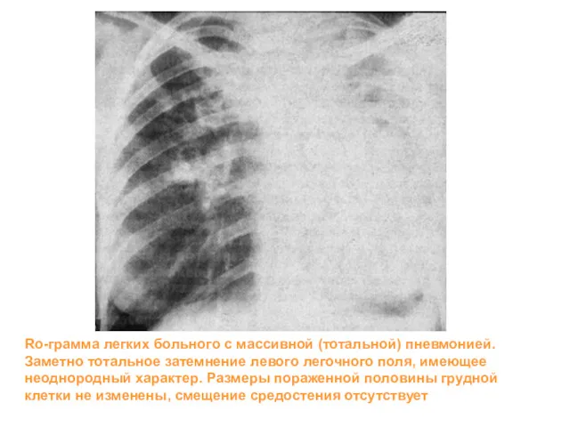 Ro-грамма легких больного с массивной (тотальной) пневмонией. Заметно тотальное затемнение