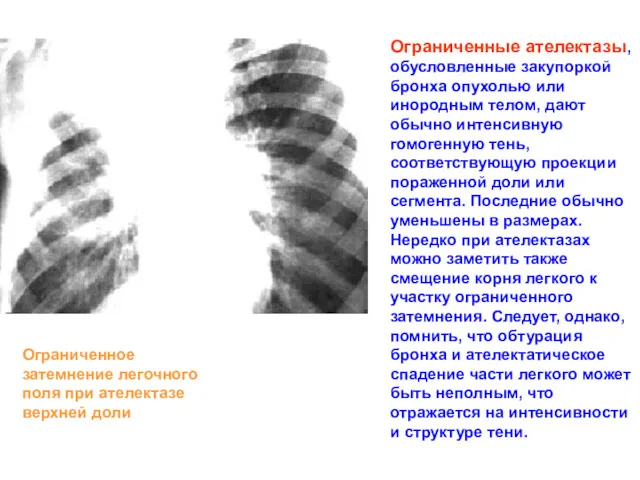 Ограниченные ателектазы, обусловленные закупоркой бронха опухолью или инородным телом, дают