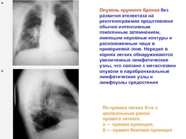 Опухоль крупного бронха без развития ателектаза на рентгенограммах представлена обычно