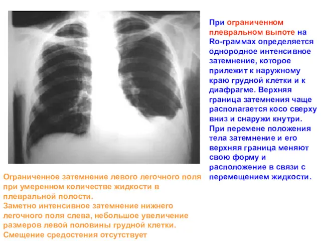 При ограниченном плевральном выпоте на Ro-граммах определяется однородное интенсивное затемнение,