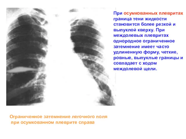 При осумкованных плевритах граница тени жидкости становится более резкой и