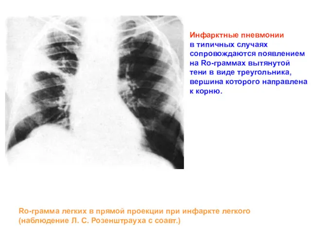 Инфарктные пневмонии в типичных случаях сопровождаются появлением на Ro-граммах вытянутой
