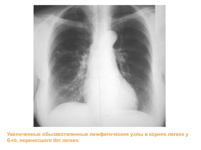 Увеличенные обызвествленные лимфатические узлы в корнях легких у б-го, перенесшего tbc легких