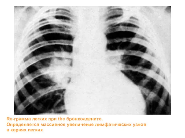 Ro-грамма легких при tbc бронхоадените. Определяется массивное увеличение лимфатических узлов в корнях легких