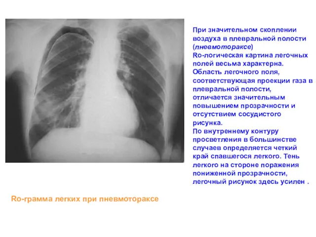 При значительном скоплении воздуха в плевральной полости (пневмотораксе) Ro-логическая картина
