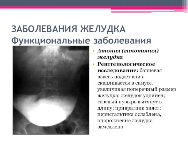 ЗАБОЛЕВАНИЯ ЖЕЛУДКА Функциональные заболевания Атония (гипотония) желудка Рентгенологическое исследование: бариевая