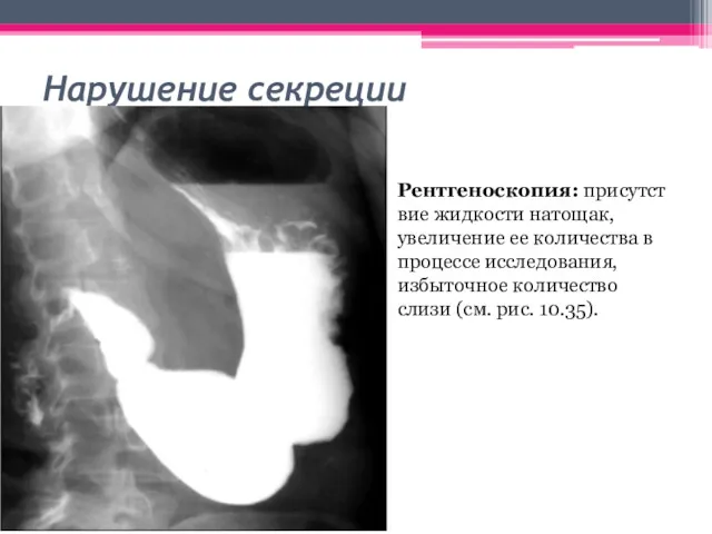 Нарушение секреции Рентгеноскопия: присутствие жидкости натощак, увеличение ее количества в