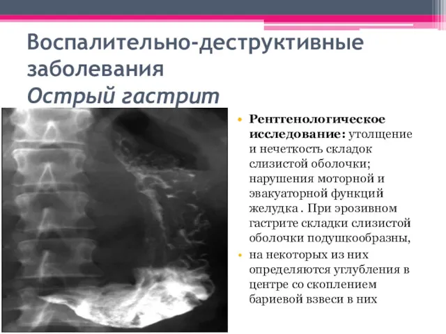 Воспалительно-деструктивные заболевания Острый гастрит Рентгенологическое исследование: утолщение и нечеткость складок