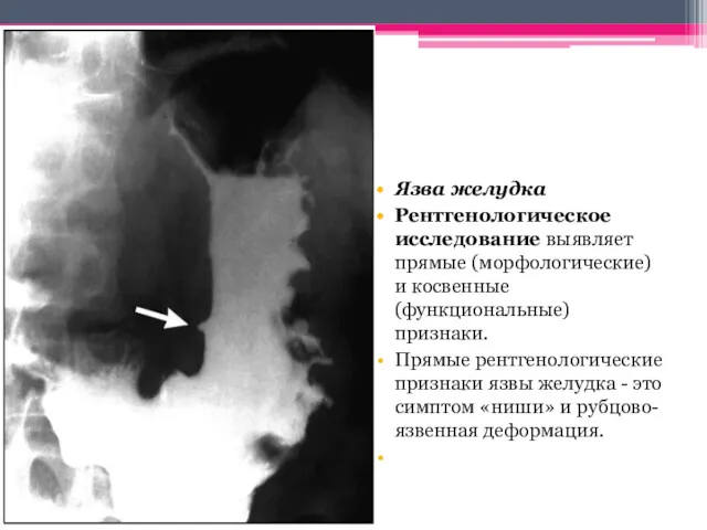 Язва желудка Рентгенологическое исследование выявляет прямые (морфологические) и косвенные (функциональные)