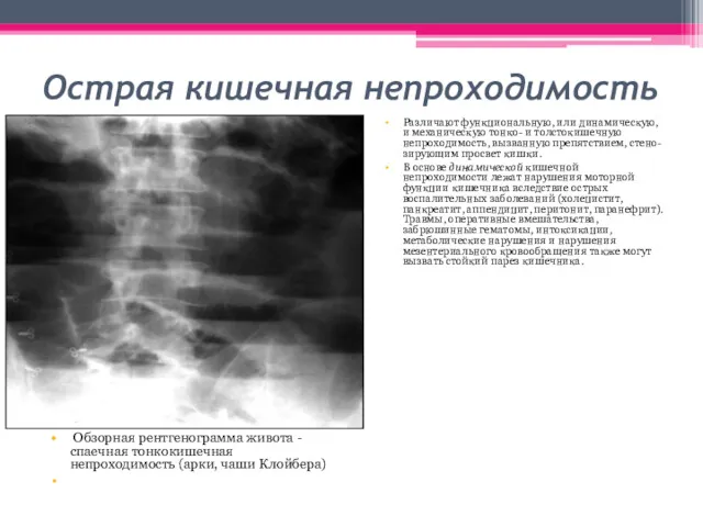 Острая кишечная непроходимость Обзорная рентгенограмма живота - спаечная тонкокишечная непроходимость