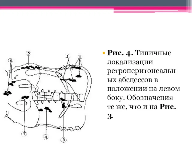 Рис. 4. Типичные локализации ретроперитонеальных абсцессов в положении на левом