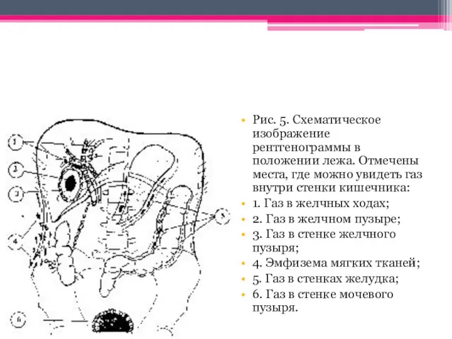 Рис. 5. Схематическое изображение рентгенограммы в положении лежа. Отмечены места,