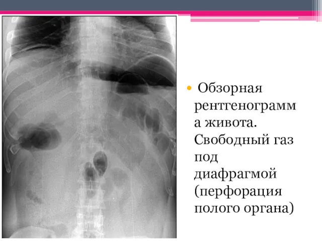 Обзорная рентгенограмма живота. Свободный газ под диафрагмой (перфорация полого органа)