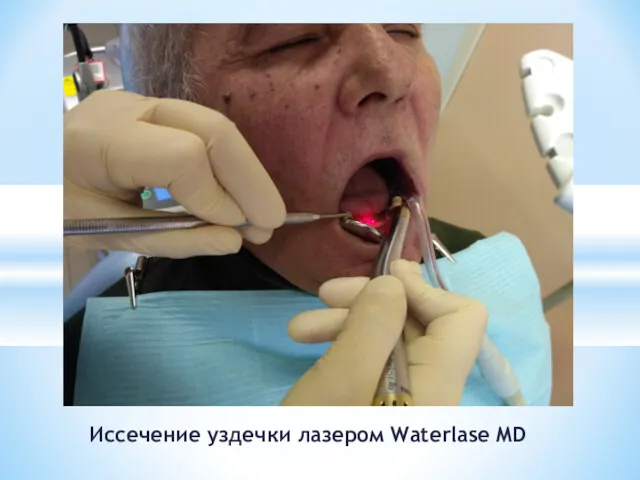 Иссечение уздечки лазером Waterlase MD