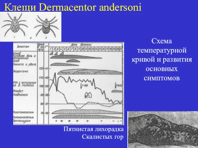 Клещи Dermacentor andersoni Схема температурной кривой и развития основных симптомов Пятнистая лихорадка Скалистых гор