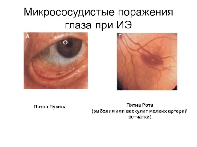 Микрососудистые поражения глаза при ИЭ Пятна Лукина Пятна Рота (эмболия или васкулит мелких артерий сетчатки)
