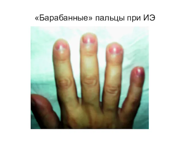 «Барабанные» пальцы при ИЭ