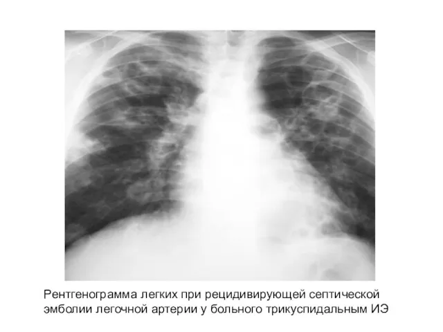 Рентгенограмма легких при рецидивирующей септической эмболии легочной артерии у больного трикуспидальным ИЭ