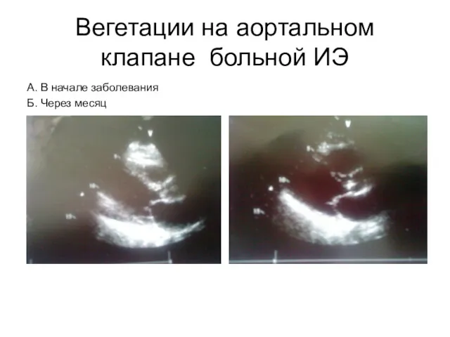Вегетации на аортальном клапане больной ИЭ А. В начале заболевания Б. Через месяц
