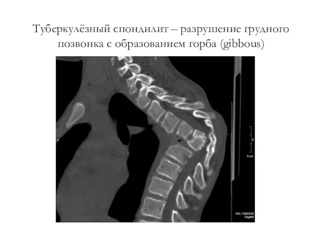 Туберкулёзный спондилит – разрушение грудного позвонка с образованием горба (gibbous)
