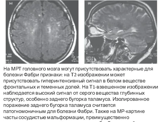 На МРТ головного мозга могут присутствовать характерные для болезни Фабри