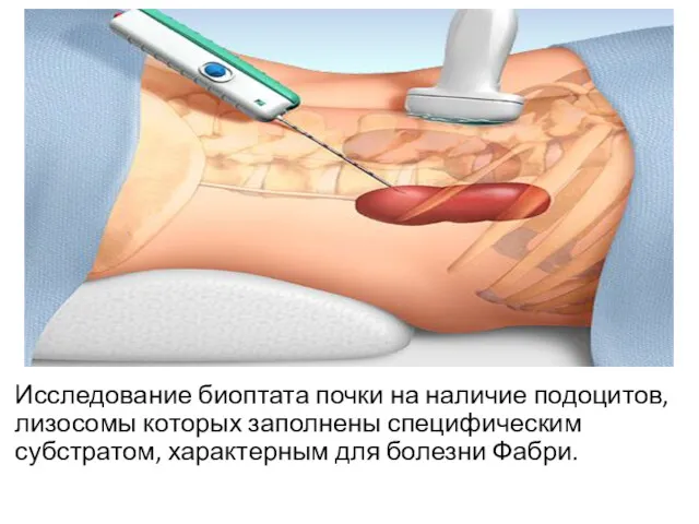 Исследование биоптата почки на наличие подоцитов, лизосомы которых заполнены специфическим субстратом, характерным для болезни Фабри.