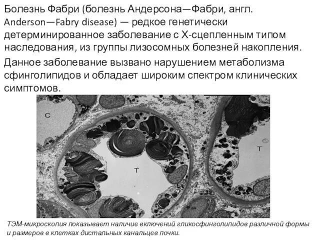 Болезнь Фабри (болезнь Андерсона—Фабри, англ. Anderson—Fabry disease) — редкое генетически