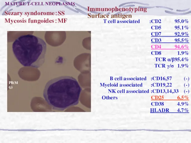 Sezary syndorome：SS Mycosis fungoides：MF Surface antigen Immunophenotyping T cell associated