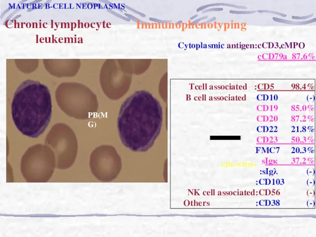 Chronic lymphocyte leukemia CD5+/CD19+ PB(MG) MATURE B-CELL NEOPLASMS