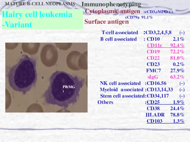 PB(MG) Hairy cell leukemia -Variant MATURE B-CELL NEOPLASMS