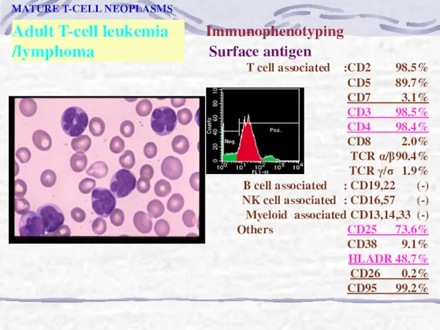 Adult T-cell leukemia /lymphoma MATURE T-CELL NEOPLASMS